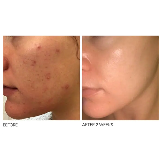 Mini Alpha Beta® Extra Strength Daily Peel